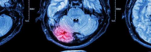brain injury MRI scan
